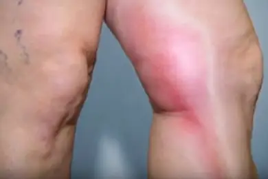 "Новогоднее заражение" жителя Кокшетау сибирской язвой прокомментировали санврачи